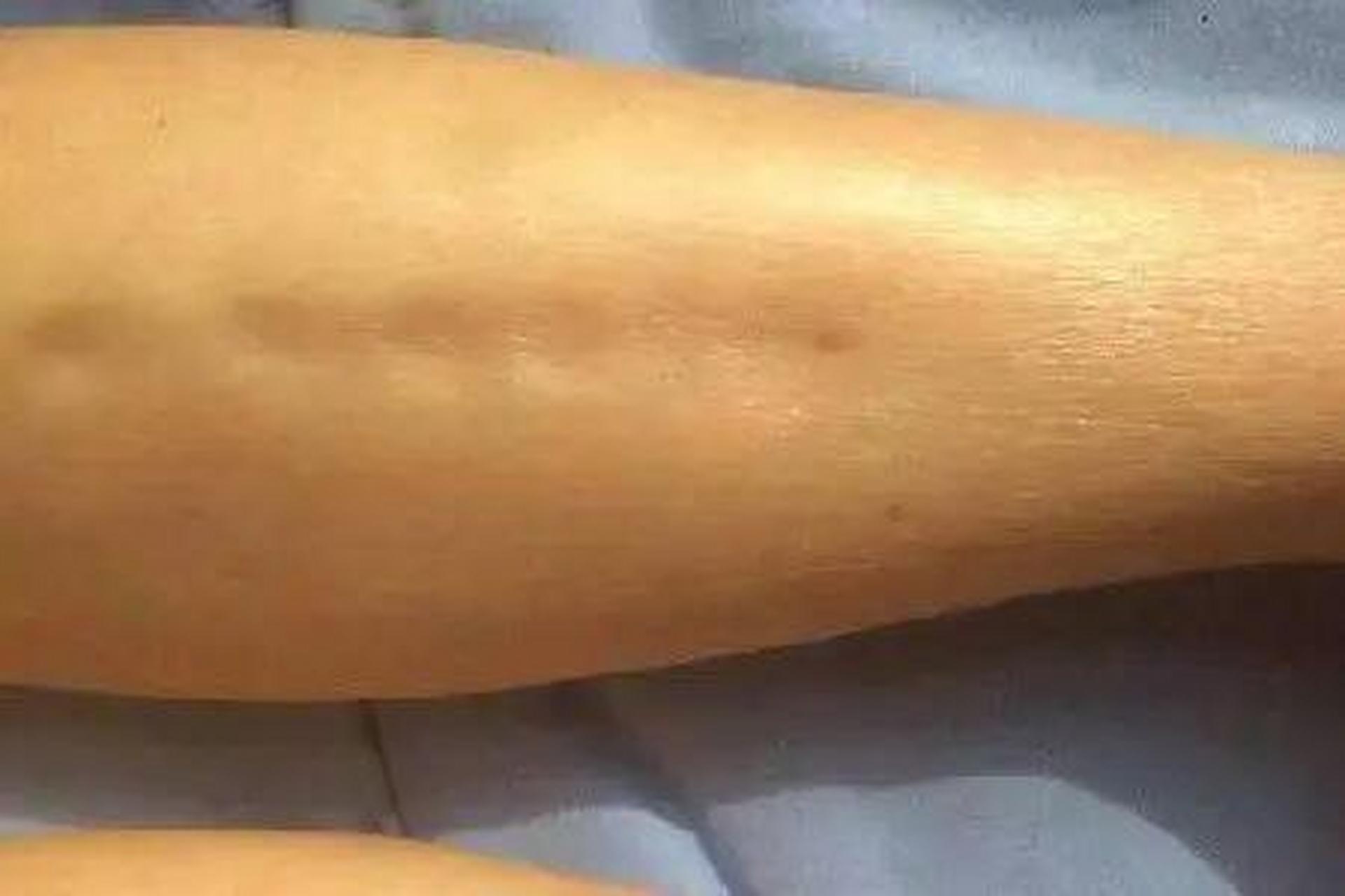 甲减引起的水肿是一种特殊的水肿,叫做粘液性水肿,患者出现这种水肿该