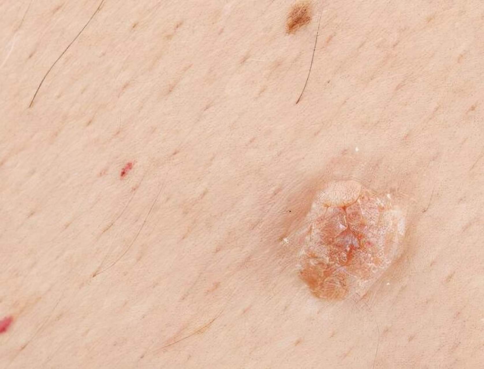 女人感染hpv,脸上会有提示,不妨多留意  1,皮肤出现红色"丘疹" 这种"