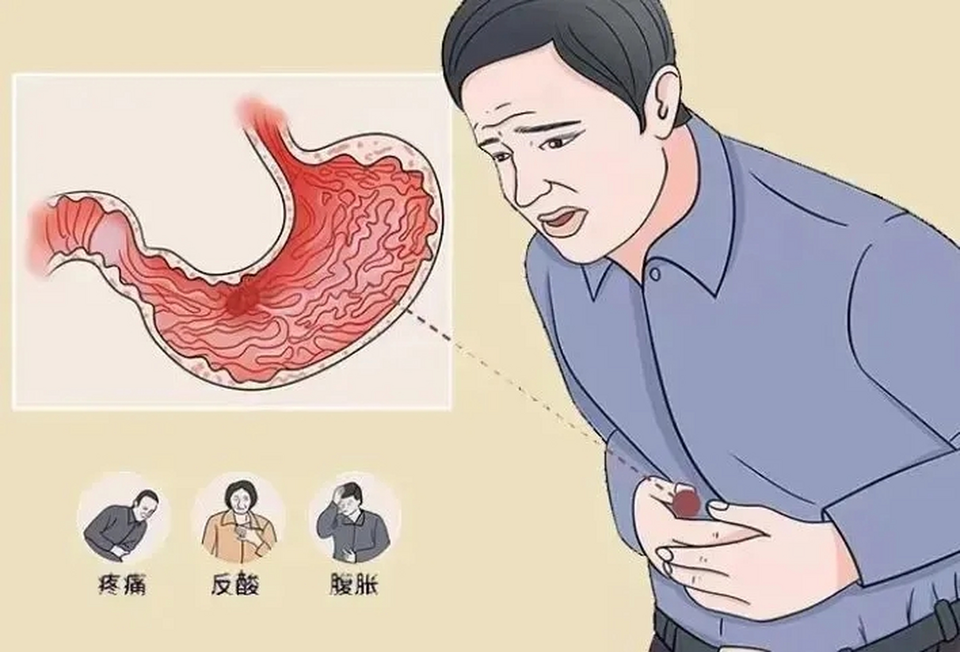 3个方法,帮你轻松修复胃黏膜 1,及时治疗,主动修复胃黏膜 胃病的治疗