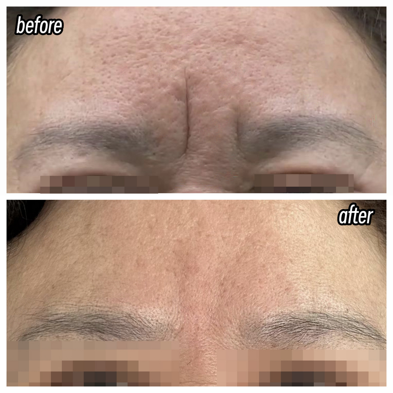 像这种重度川字纹是一种静态纹,即使你不做任何表情,也会存在的皱纹.