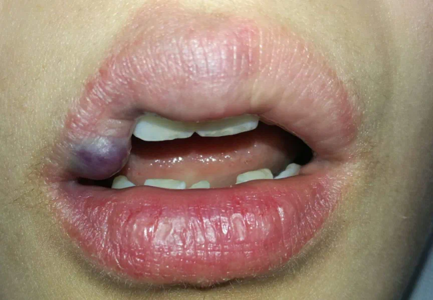 静脉畸形是一种先天性血管发育异常,通常由于毛细血管和静脉之间的