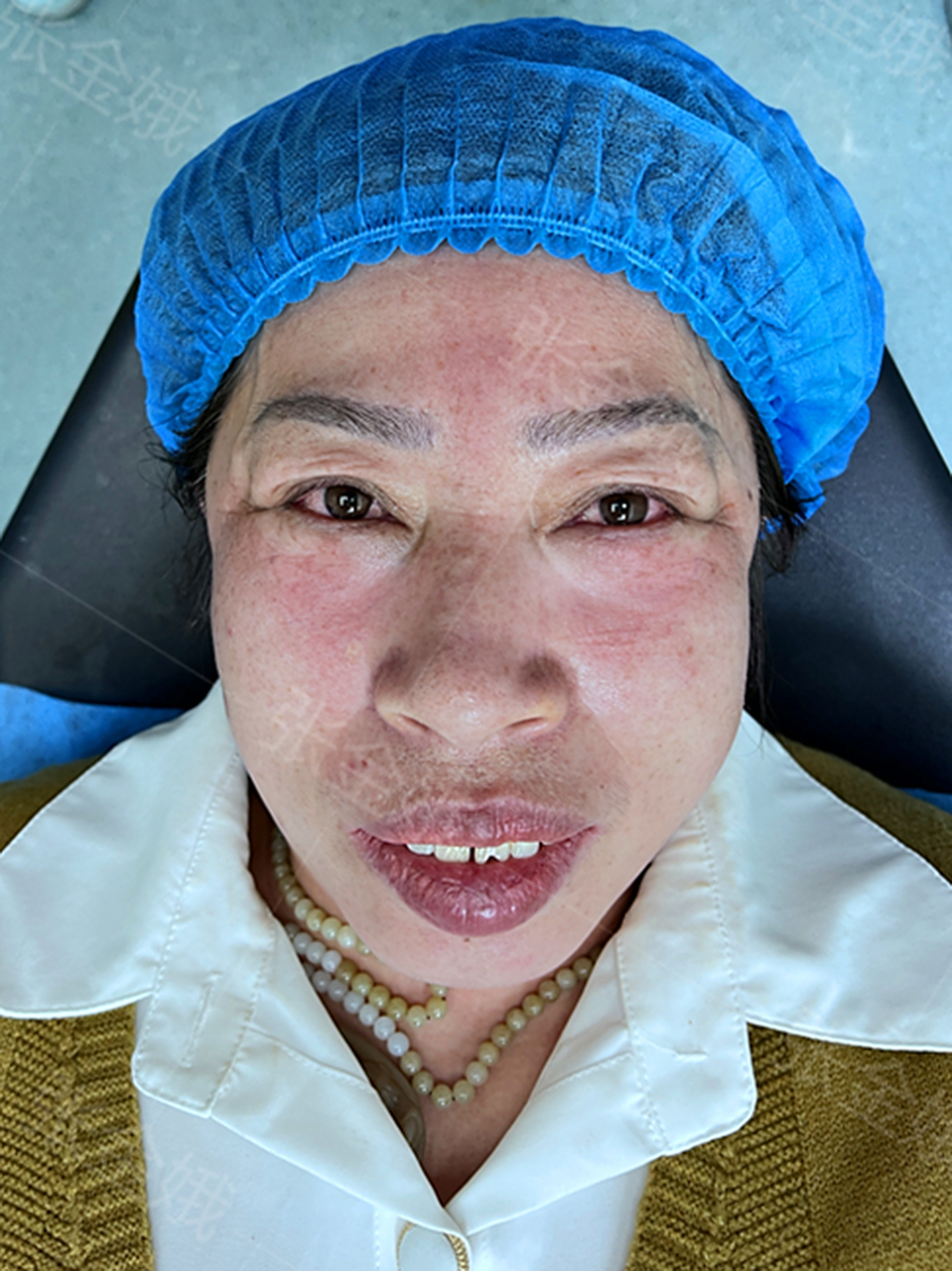 眼袋重度膨出,且伴随泪沟,皮肤松弛问题,是属于典型的混合型眼袋