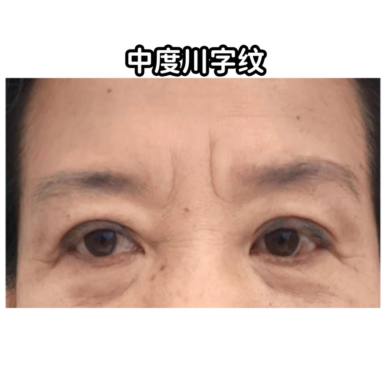 对于轻度,中度的眉间川字纹,采取一些简单有效的方法可以显著改善面部
