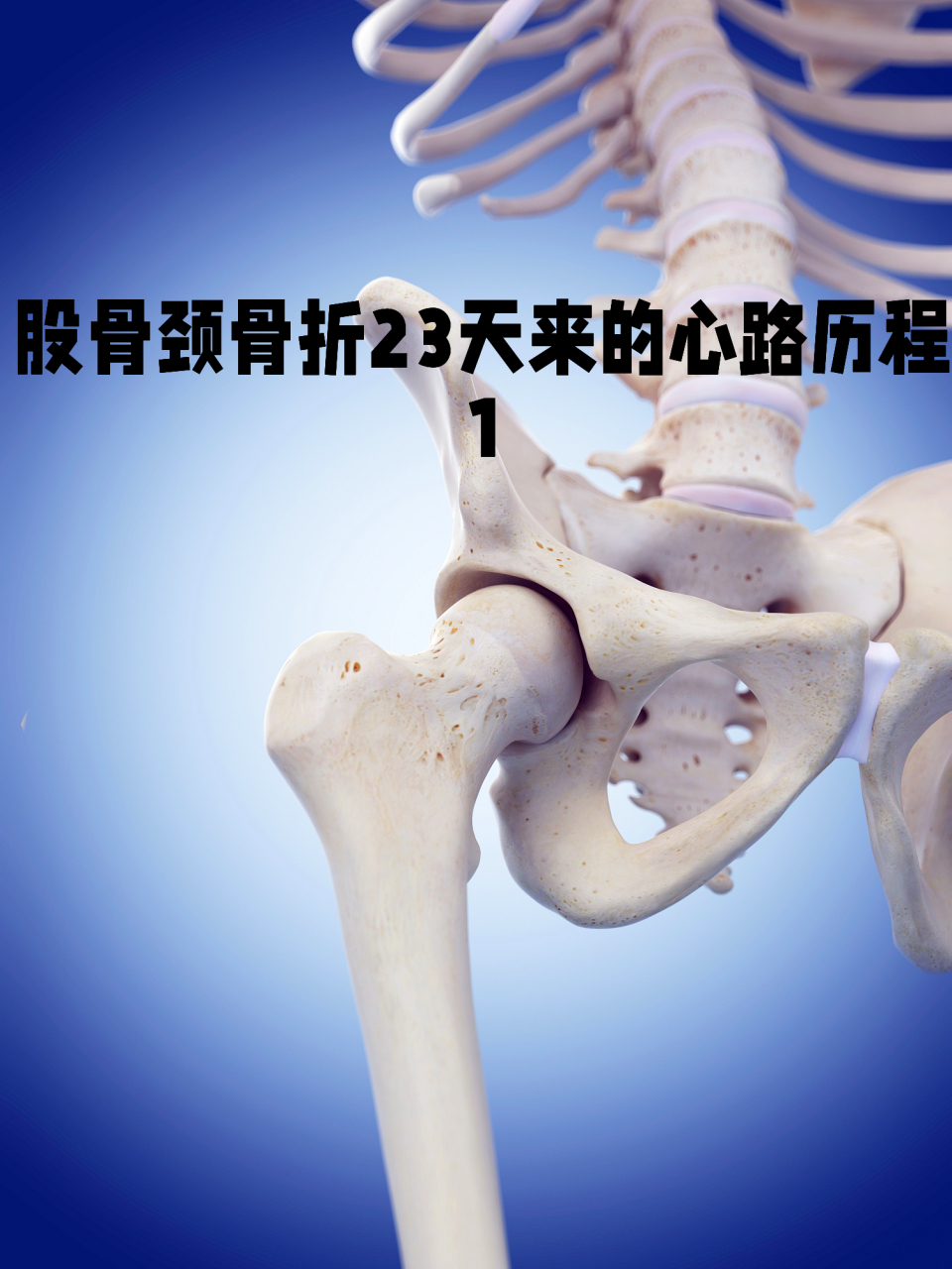 股骨颈骨折23天来的心路历程 1 #股骨颈骨折# #疾病治疗经验# #健康