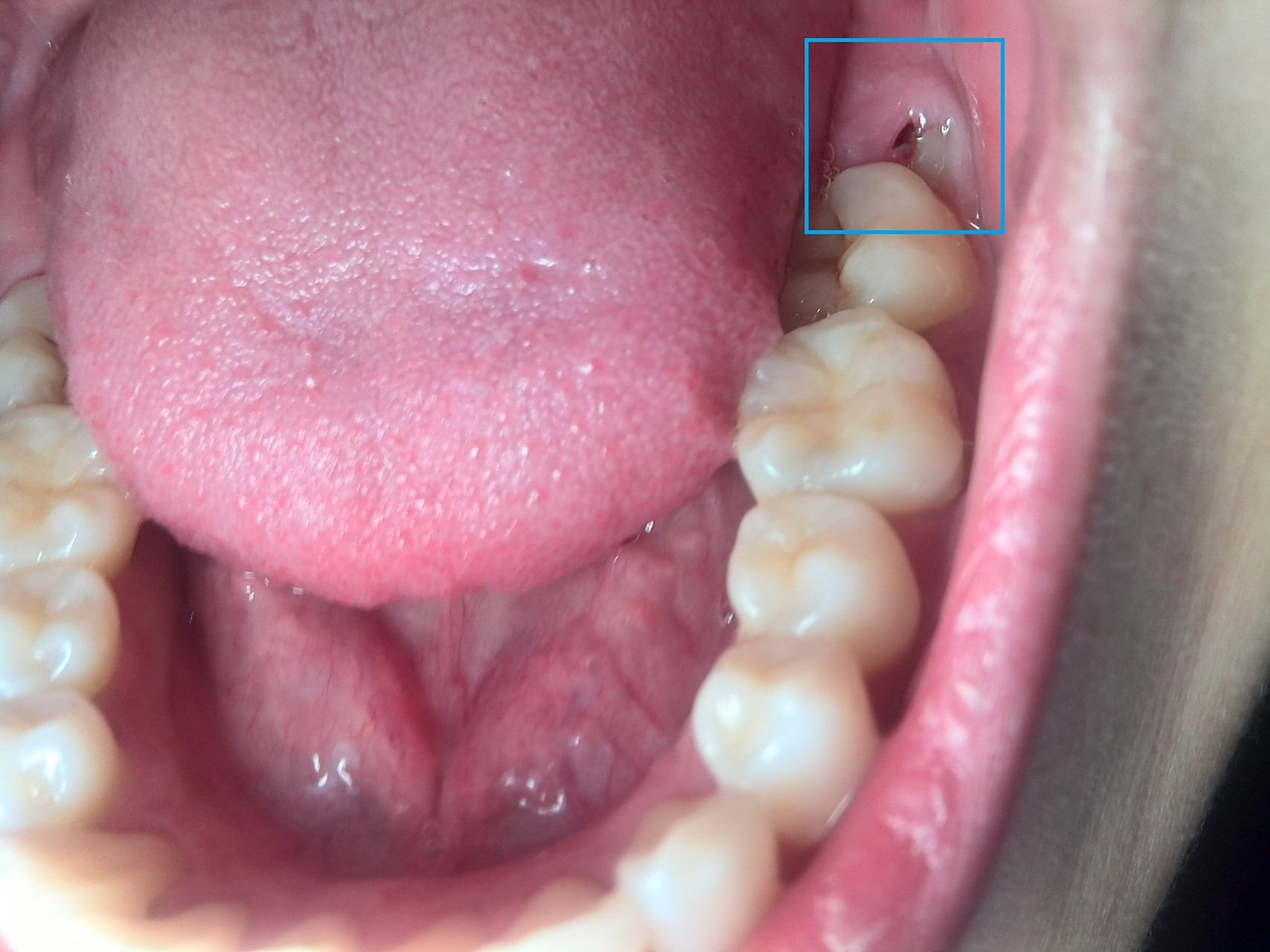 [我看我朋友那智齿发炎了,半个脸都肿了,别说他疼了,我看着都疼
