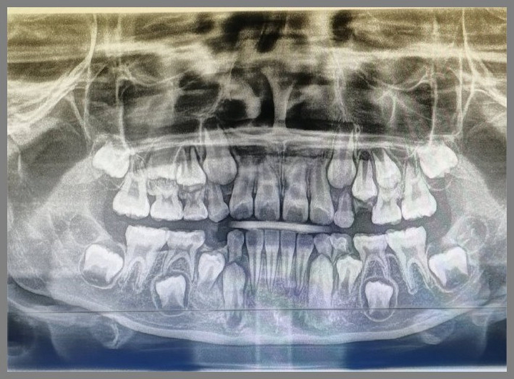 换牙期小朋友的牙片可以清楚看到有四排牙齿 (还有两颗是长在眼睛下方