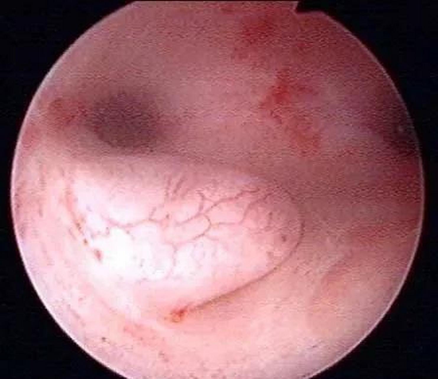 头号创作家# 子宫内膜息肉属于良性病变,是子宫内膜增生导致.