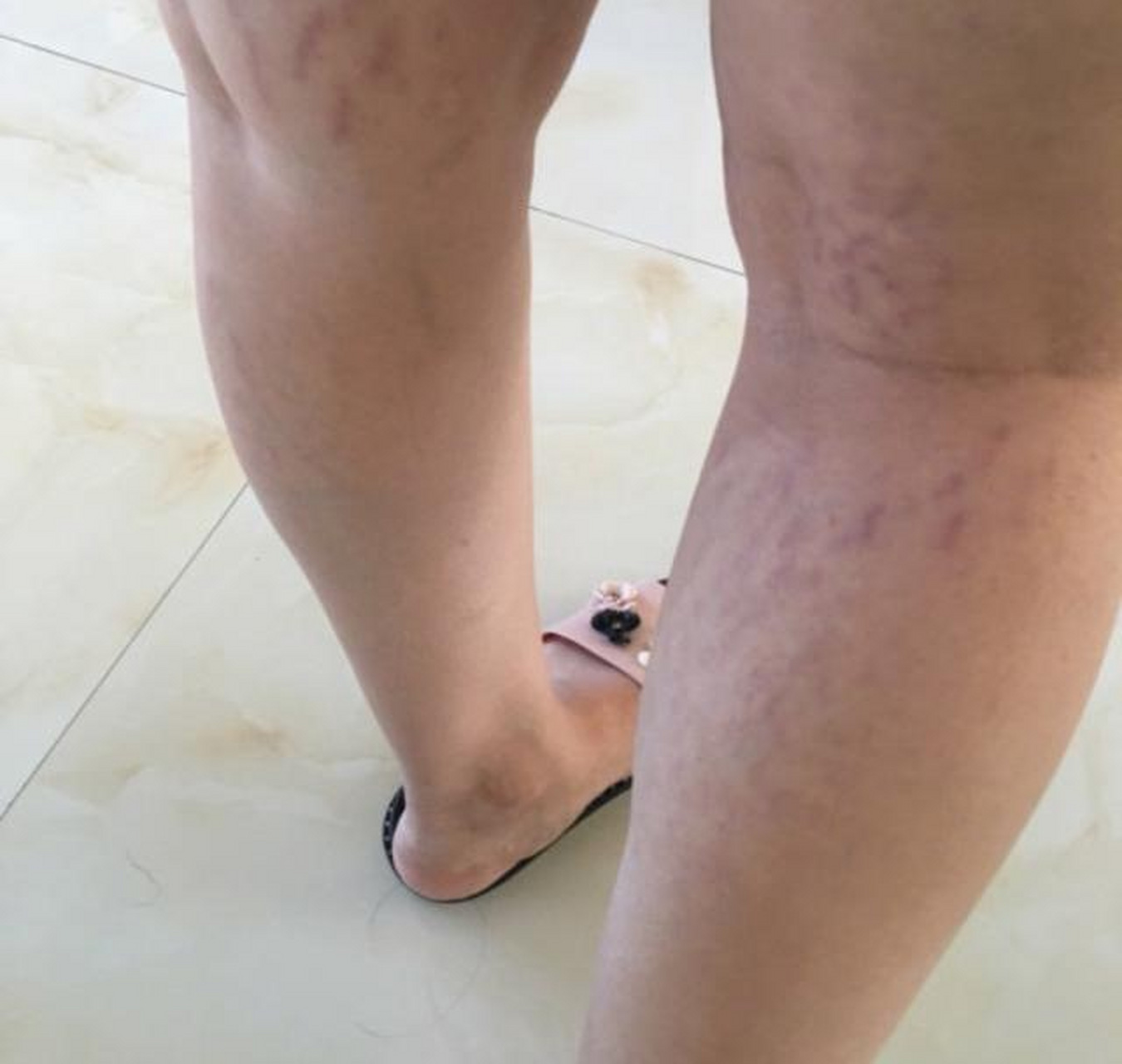 肥胖纹是什么样的图片  肥胖纹是由于体重快速增加或减少导致皮肤的