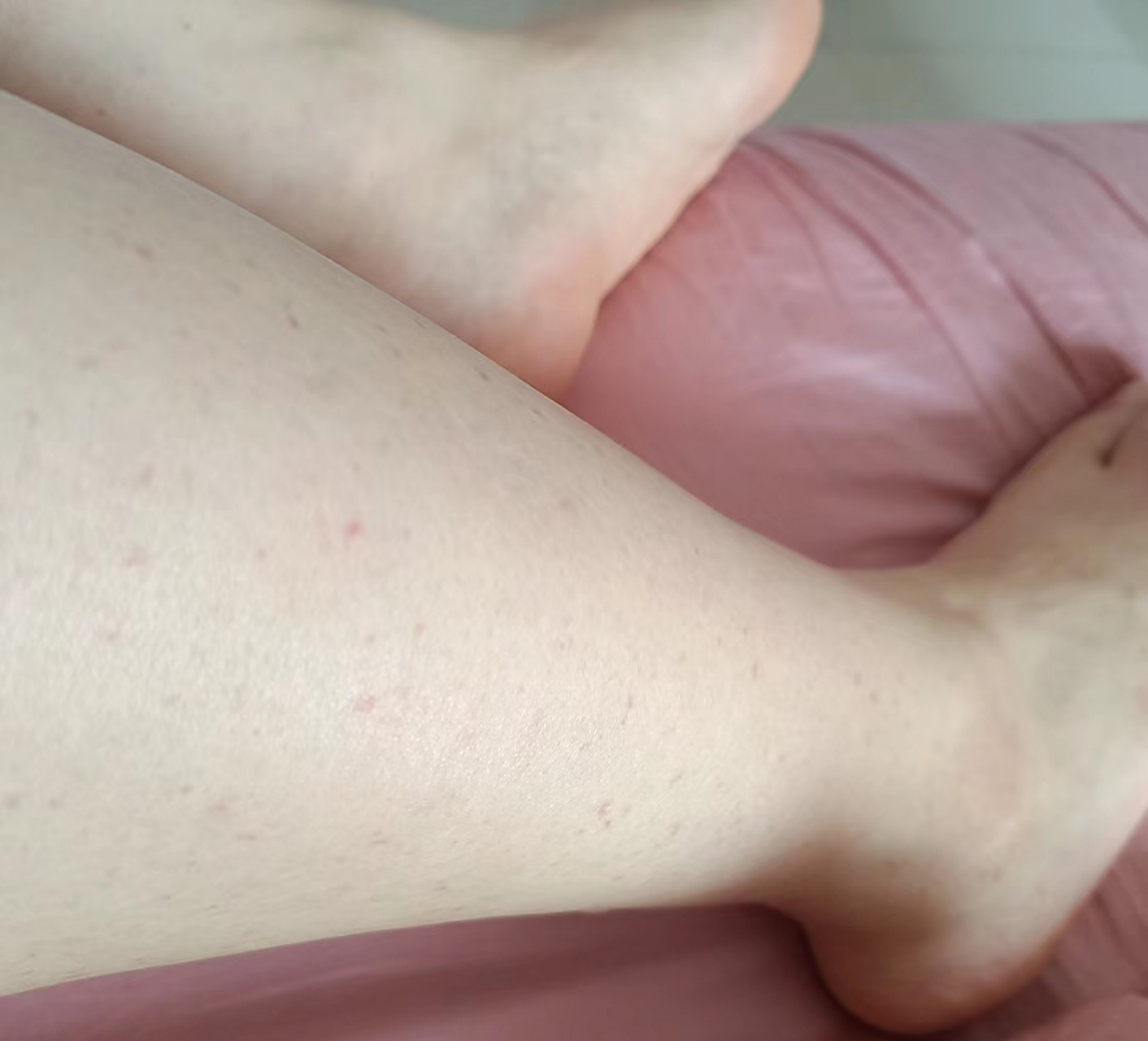 二阳后出现了这些红疹,去医院检查说是过敏性紫癜,现在吓得什么都不敢