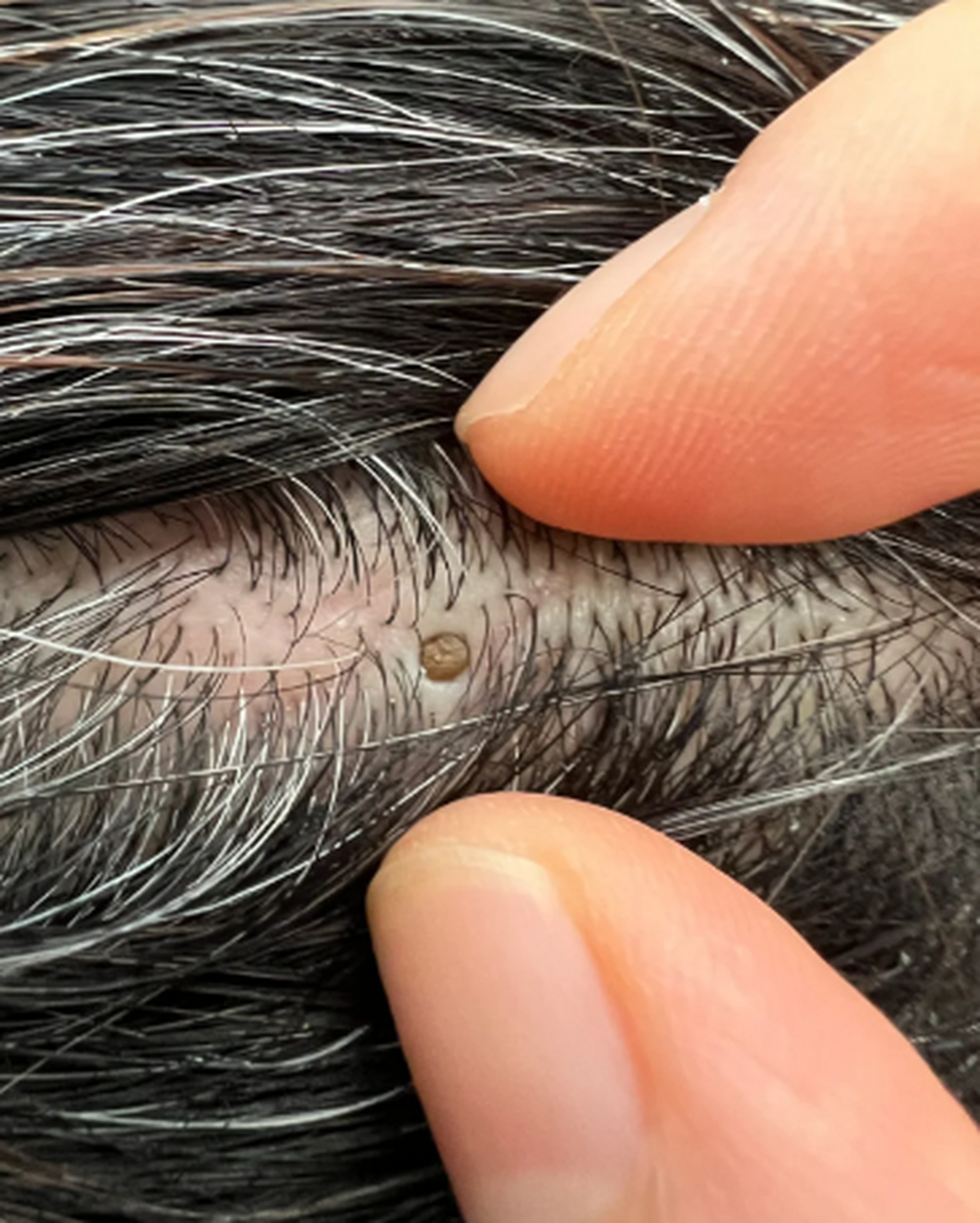 头上有个巨大黑头怎么办