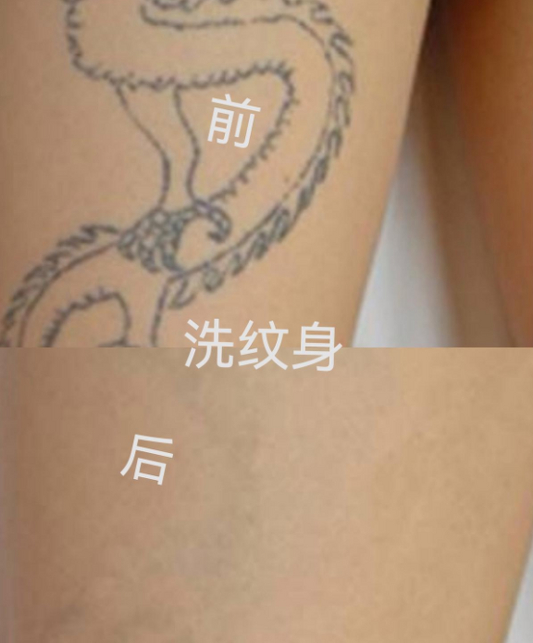 激光洗纹身是目前最常用的方法之一,可以让人快速洗掉不想要的纹身