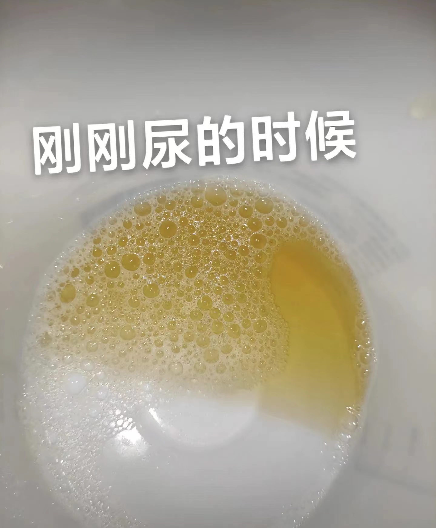 最近有粉丝问我为什么我的尿蛋白没有消失反而多了?