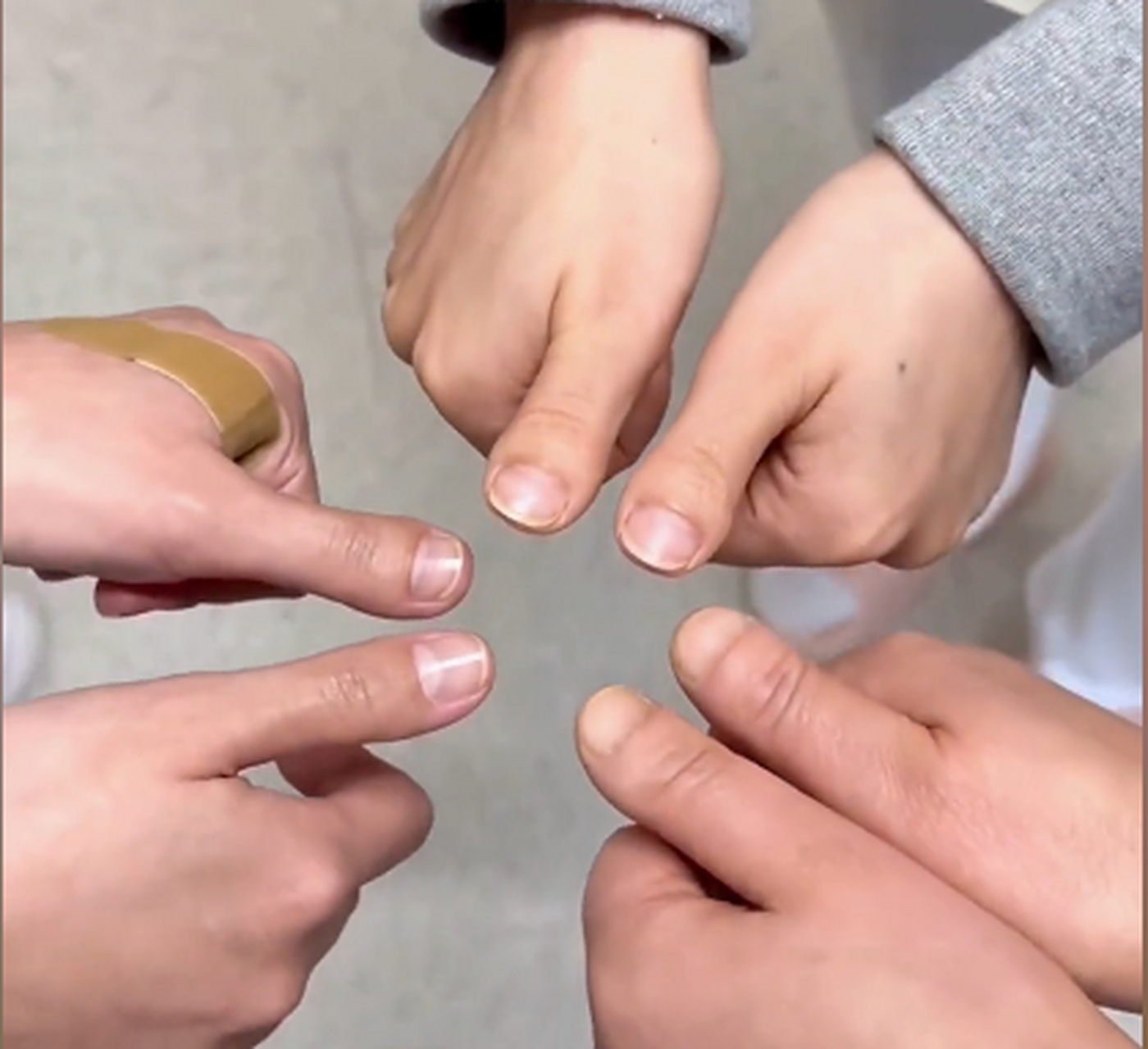 短指症(脚趾)患者在我这做完手术后,在网络上回答的问题,仅是患者个人