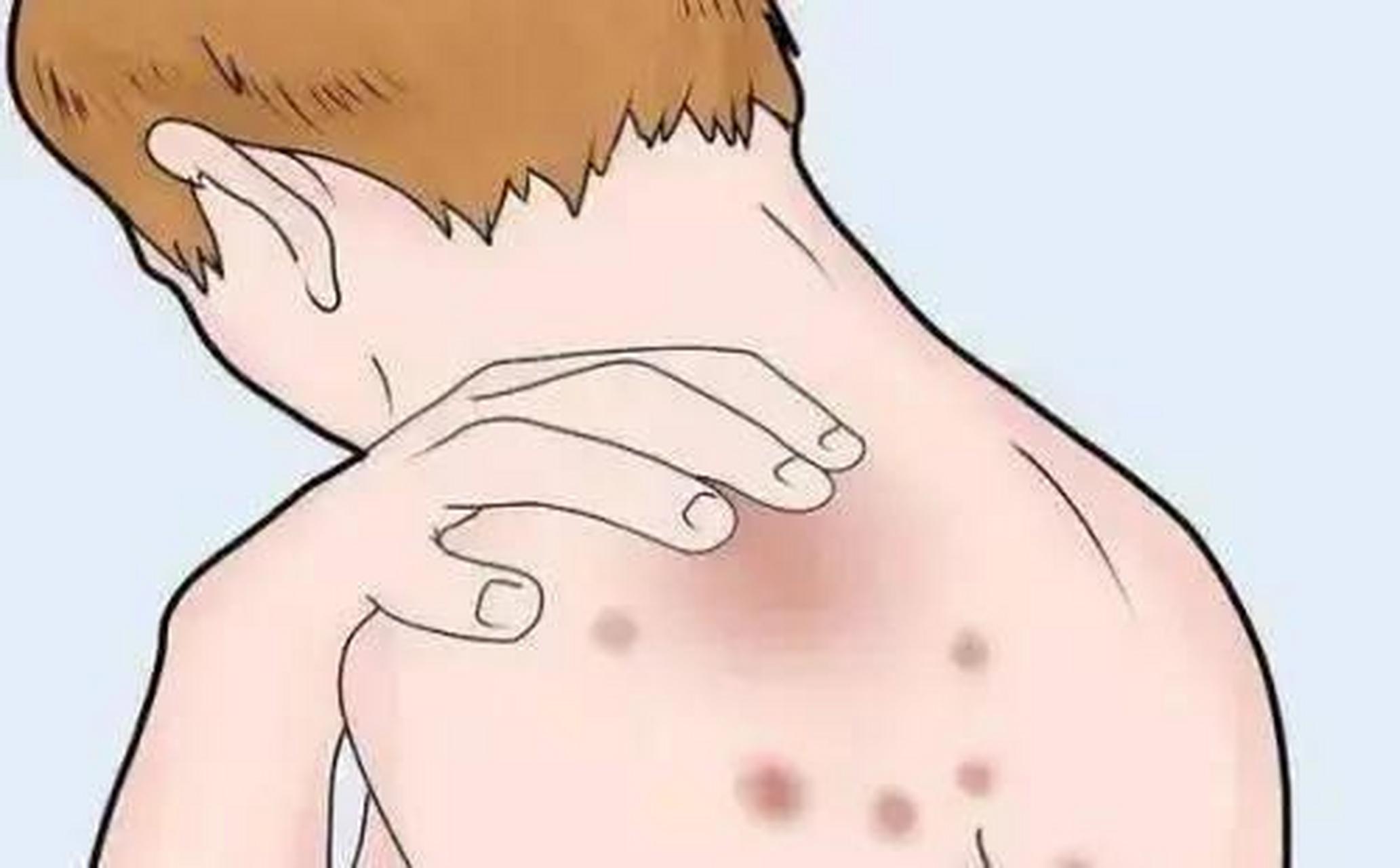 体癣常常会因为自身传染而变得严重起来,体癣有时候会病变,病变成为