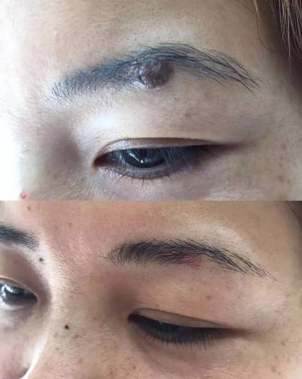 祛痣的几个坑千万别踩!