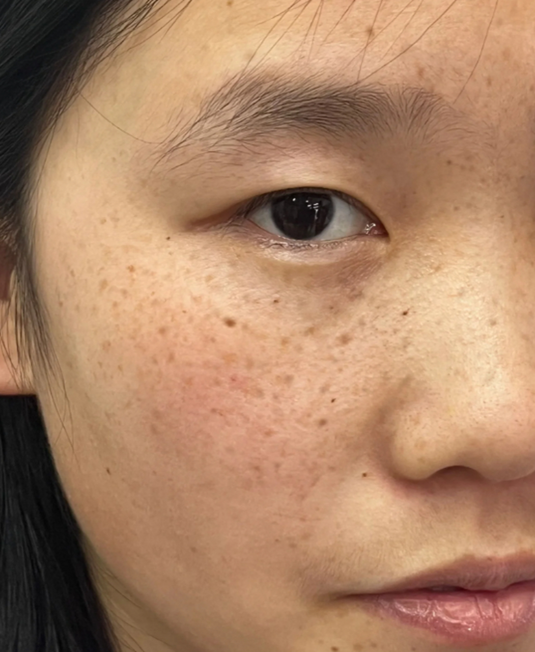 色素斑,是指皮肤表面出现的一种色素沉着的病变.它可以呈现出不同颜色