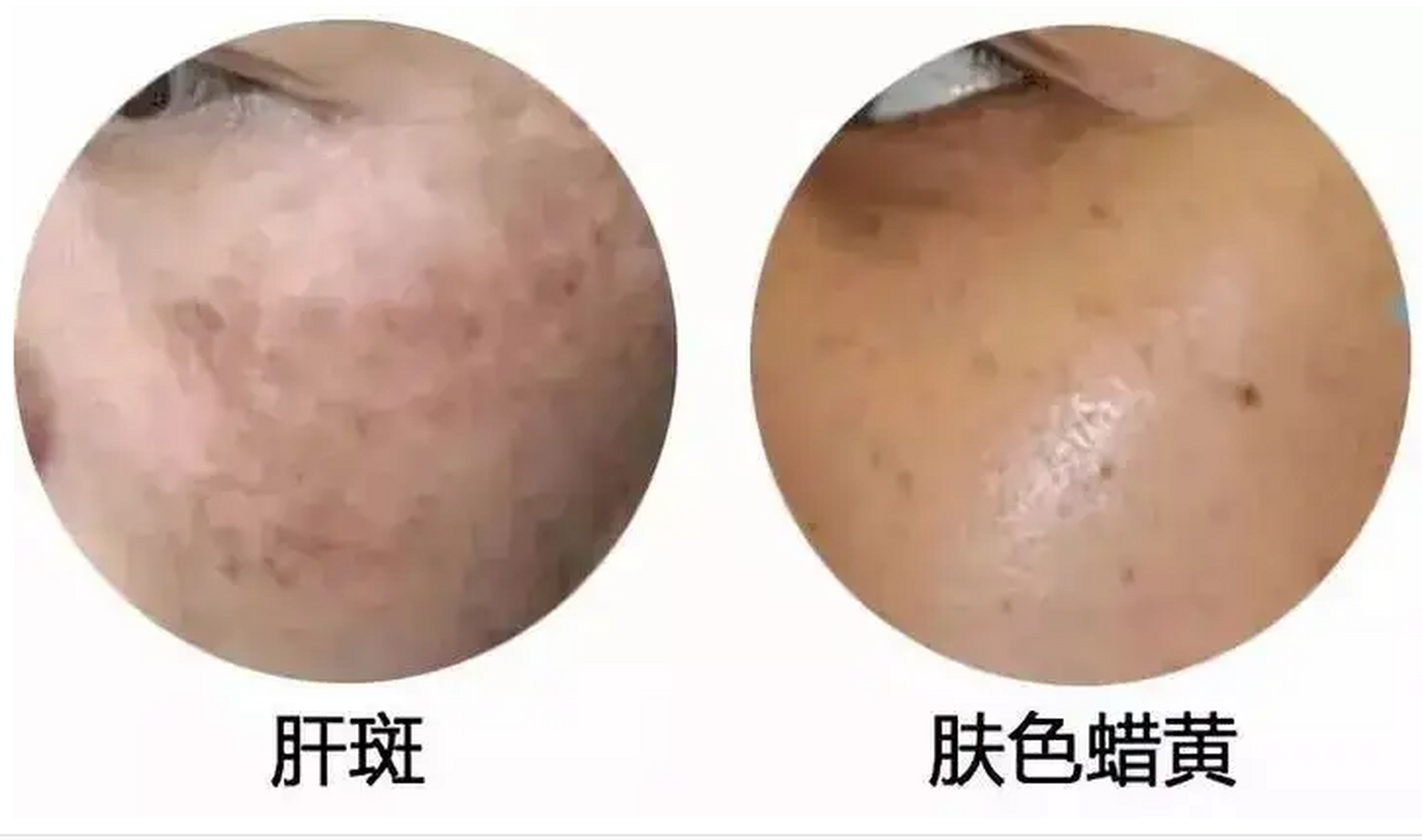 吃饭不香,脸上长斑,典型的肝郁脾虚 肝郁之后容易造成脾虚,脾气虚主要