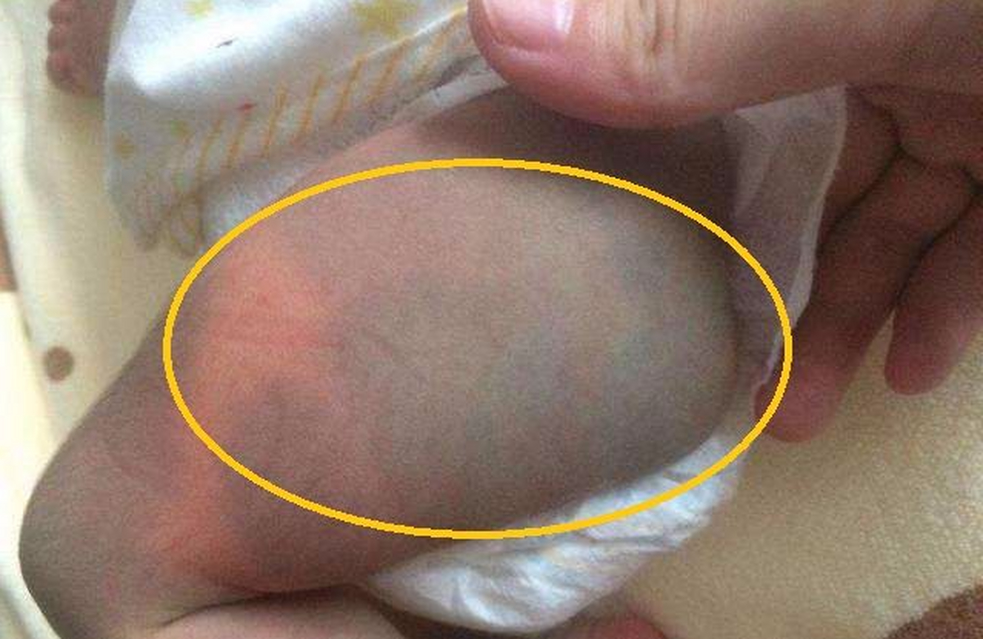 【屁股长胎记,会对宝宝的健康有影响吗?