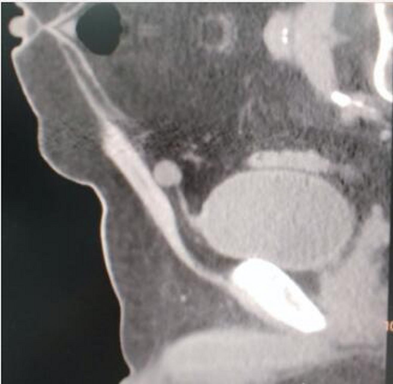 【脐尿管囊肿】  图1,脐尿管囊肿示意图;图2,ct扫描矢状位重建图像