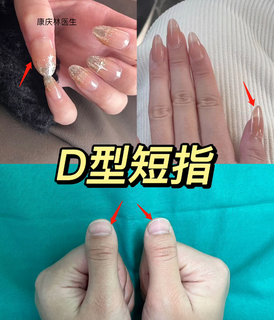 d型短指术前术后对比: #短指# #指甲# #d型短指# #手术