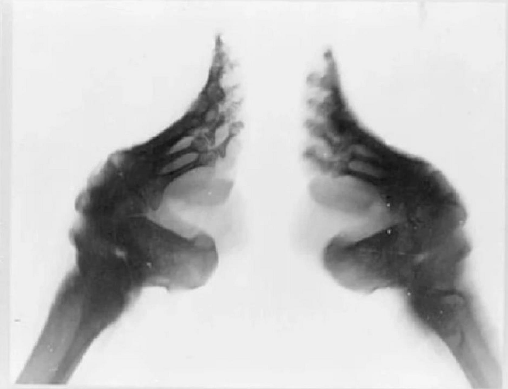 这是一张缠足女子的x光照片,从画面中可以直观地看到,她的骨头已经