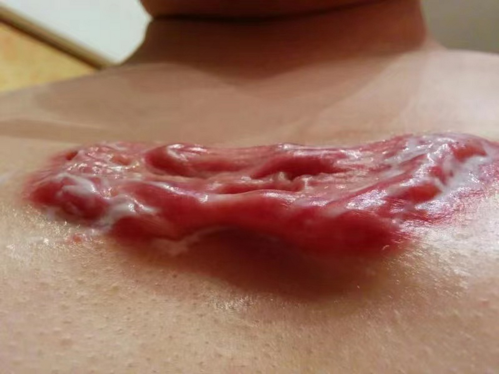 因前胸疤痕疙瘩在外院被各种治疗方式折腾一番,手术