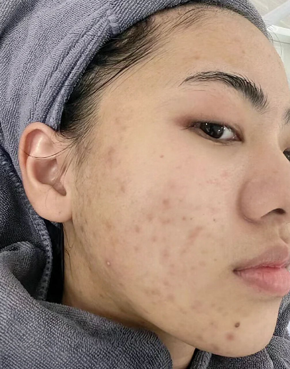 黑色痘印怎么消除怎样淡化最快 #医美科普挑战赛#