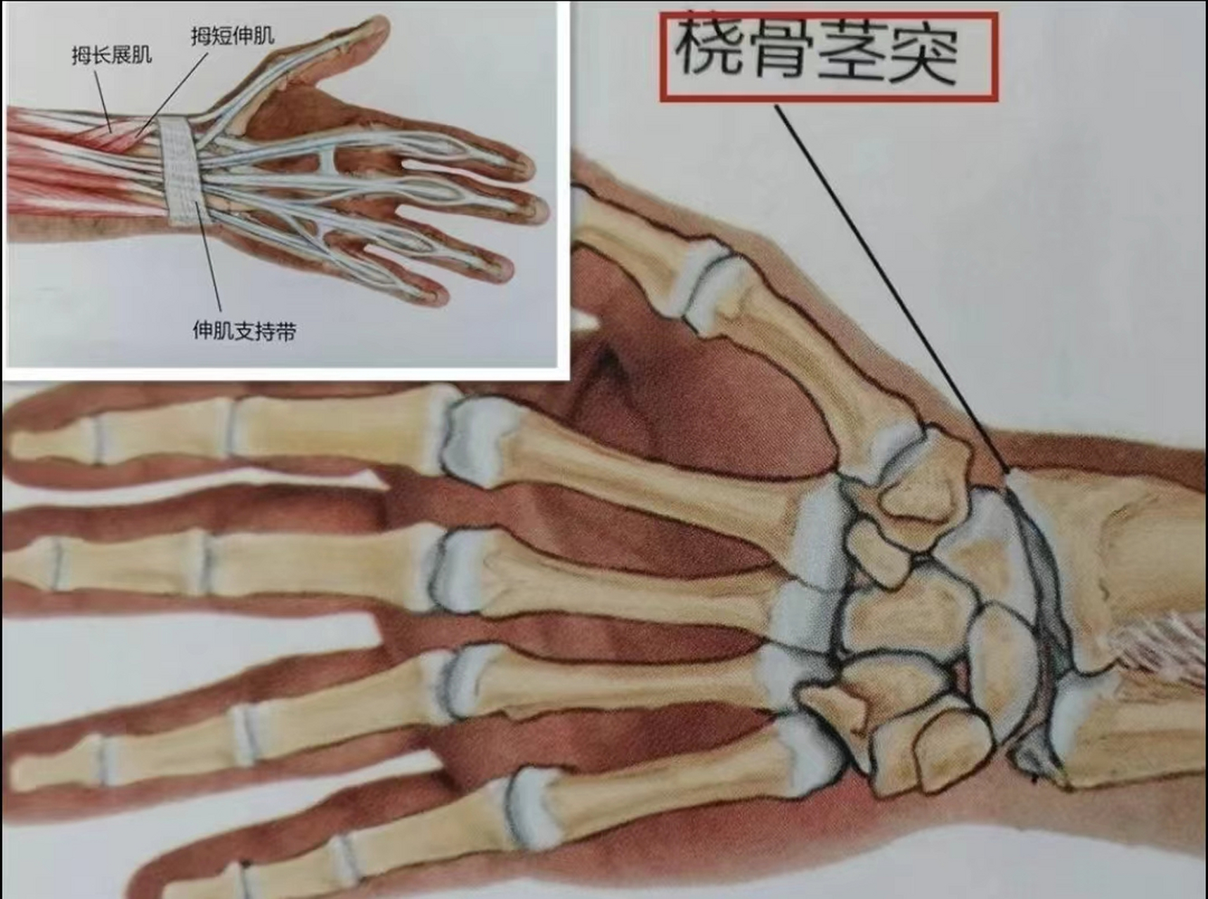 手腕酸疼,也许是腱鞘炎!试试这个法子!  该说不说!