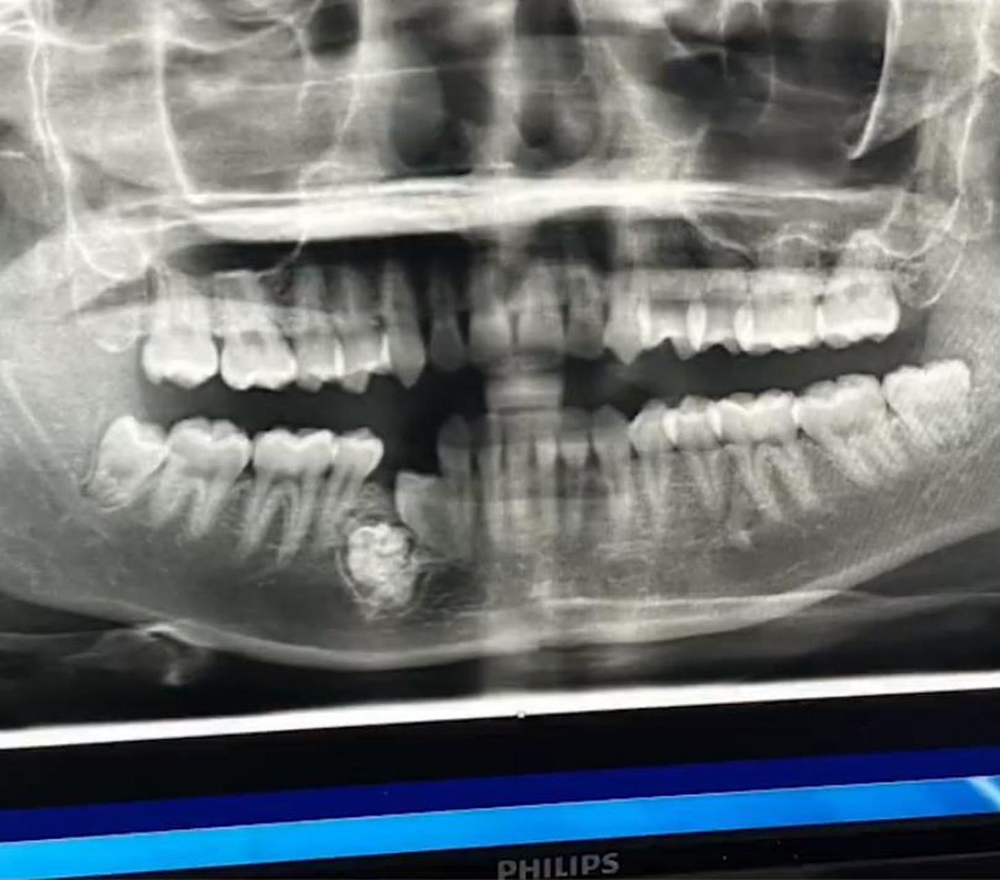 近日,一女生因缺一颗牙确诊牙瘤拔掉57颗牙,引发全网关注