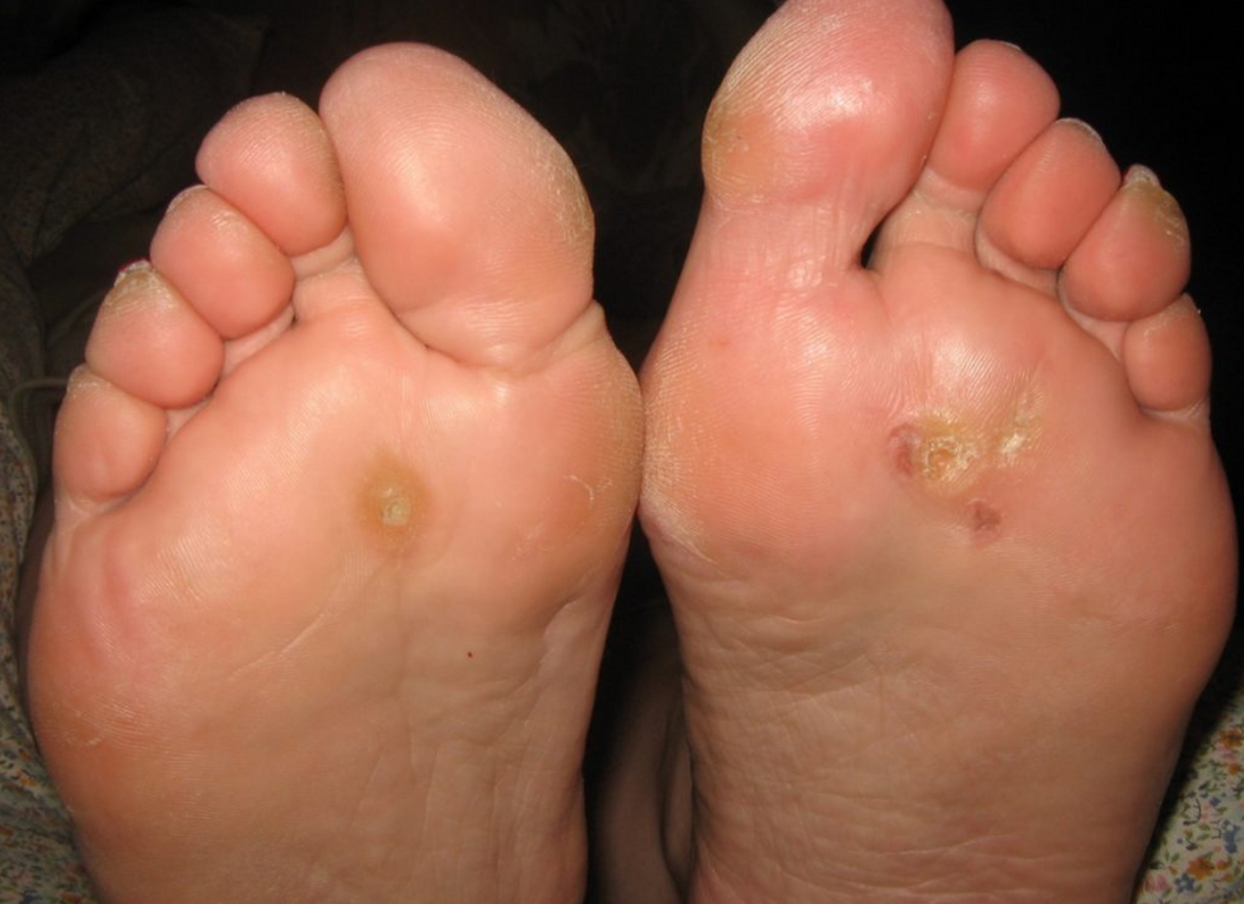 跖疣是一种寻常疣,常常发生在足底,俗称"瘊子","刺瘊".