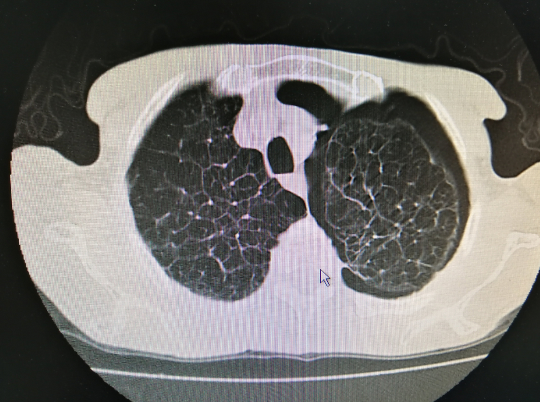肺大泡是肺气肿吗?肺大泡肺气肿的区别是什么?  很多患者以为肺大泡就