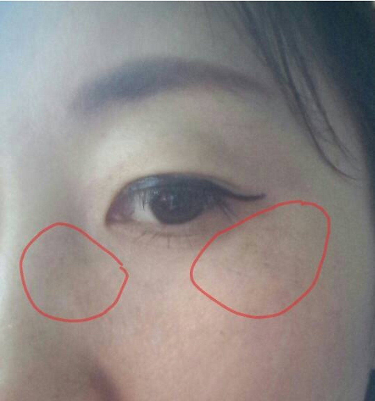 眼角长斑是指在眼睑或眼角周围出现的色素沉着或色素斑点.