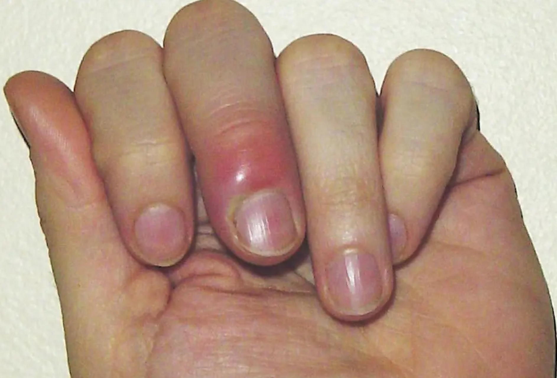 甲沟炎有多普遍?