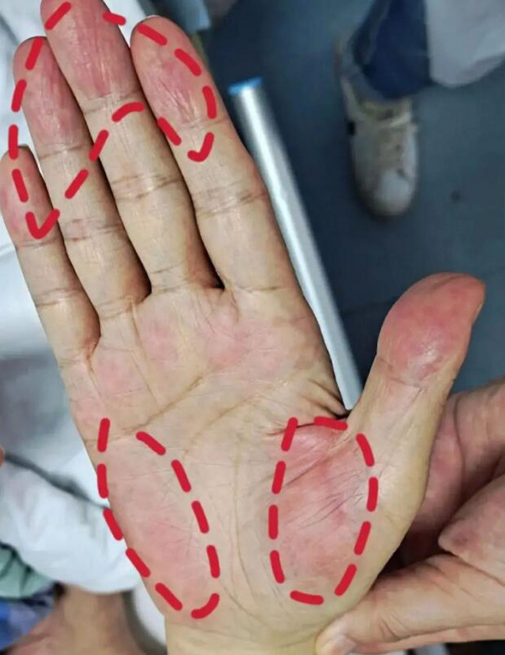 接诊了一位患者,刚39岁,我看他一伸手就有明显的