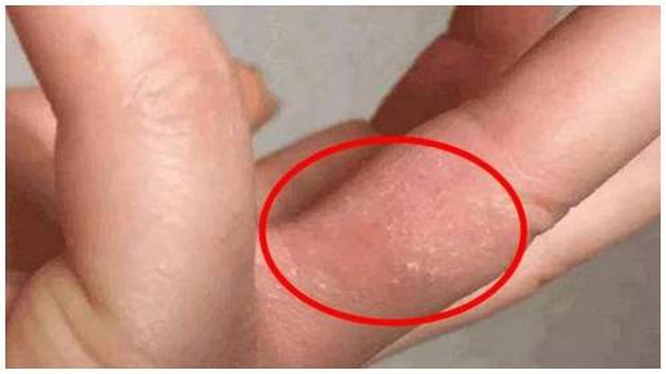 手上突然长透明"小水泡",还很痒?注意:这是身体发出的"求救"信号!