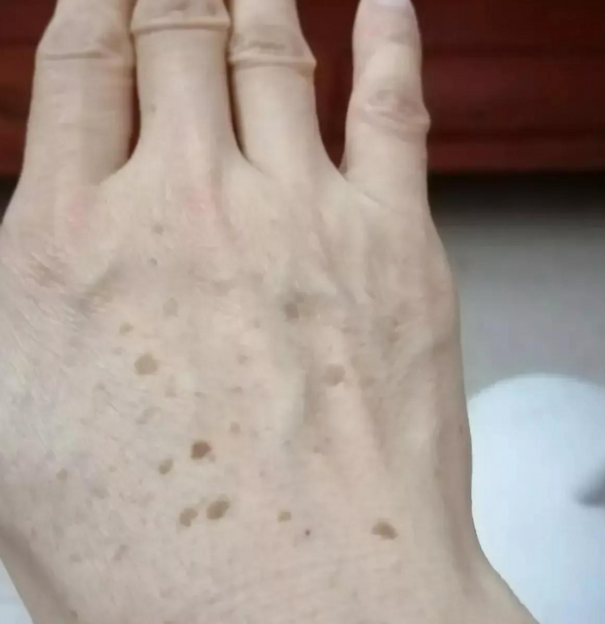 今年才36岁,就开始长老人斑了吗?