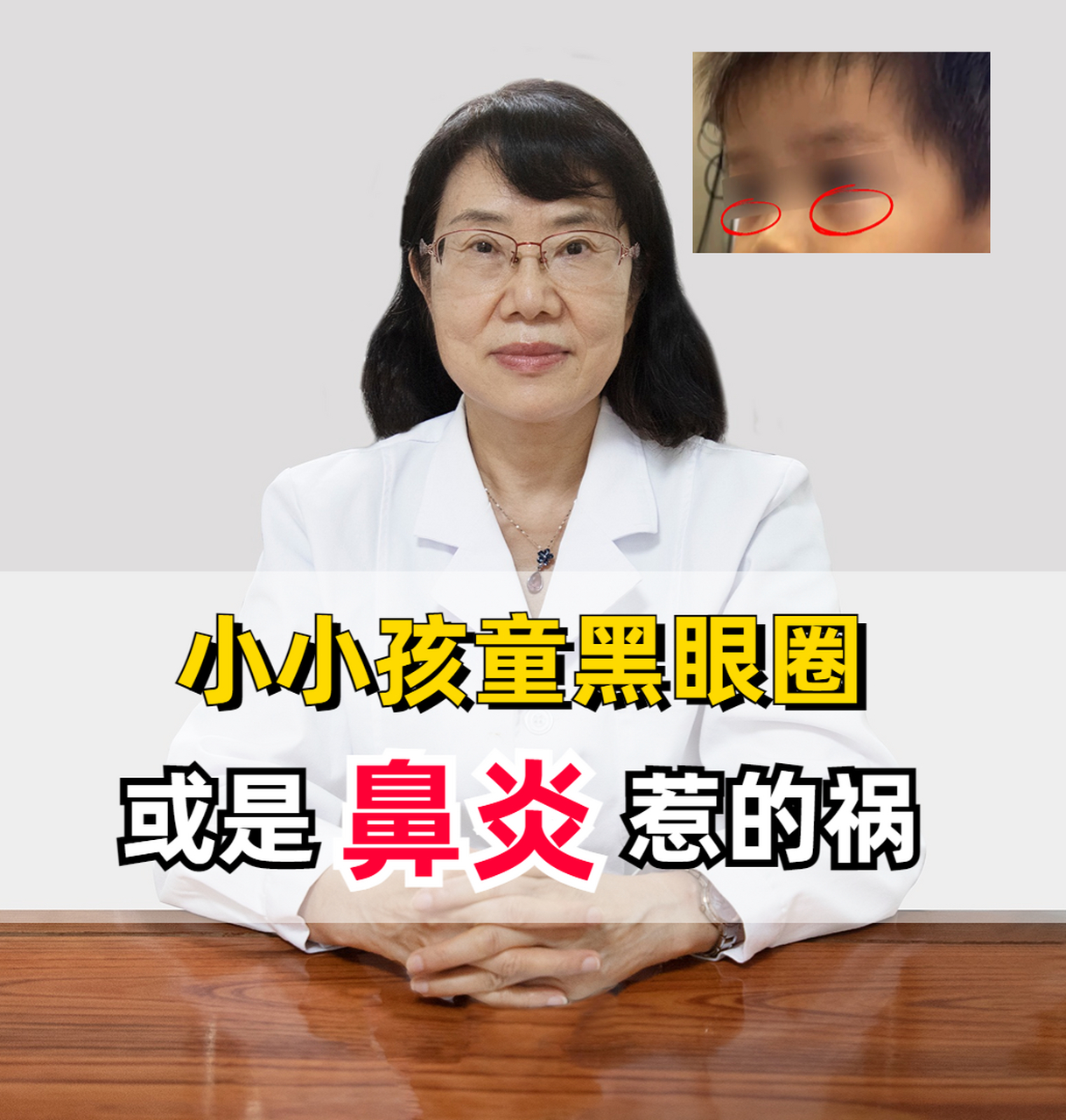 这种黑眼圈,我们又称之为过敏性眼影,这些孩子呢,可能有鼻炎,过敏性