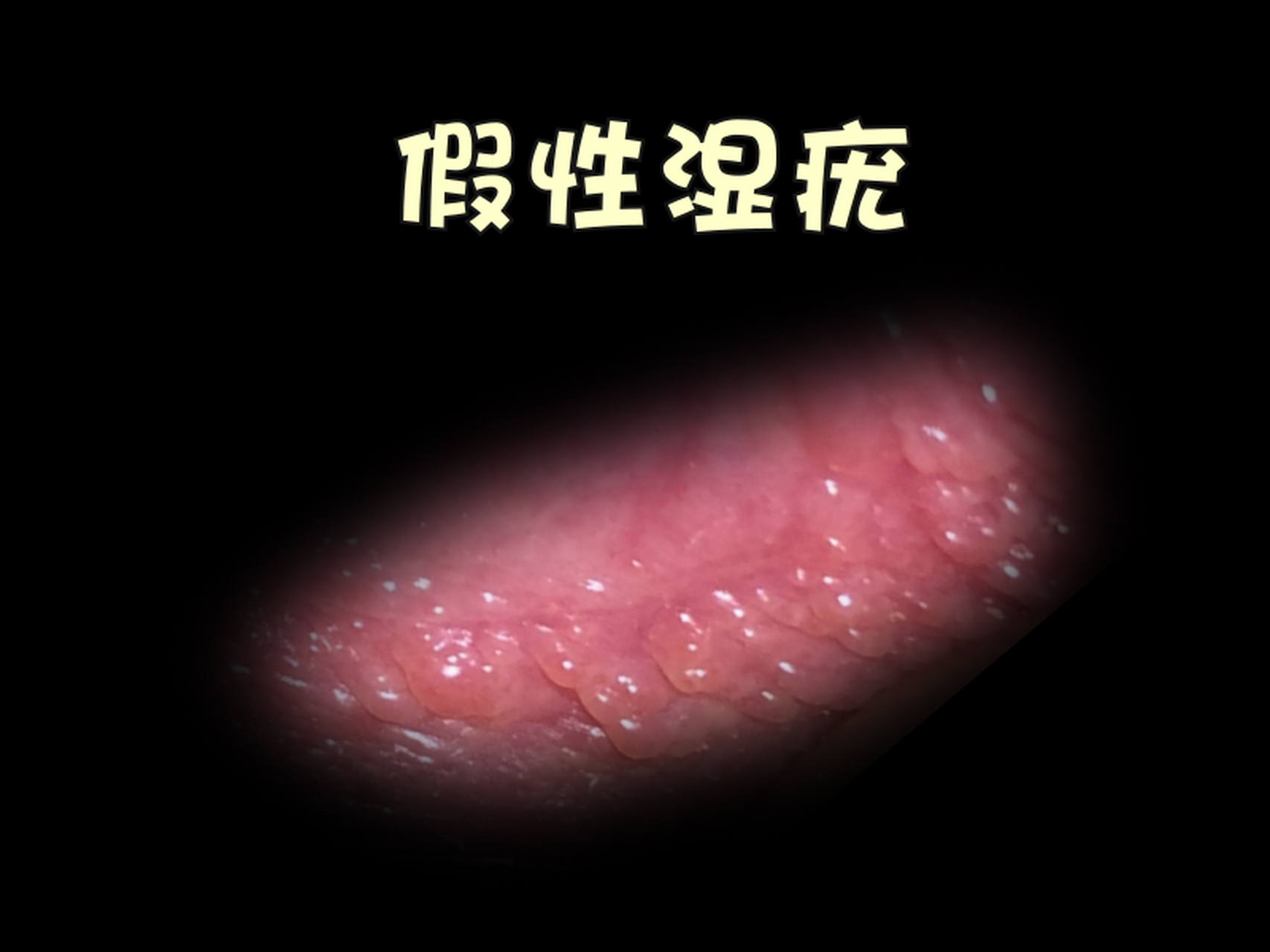 疣体的分布: ·尖锐湿疣不仅出现在生殖器官周围,肛周也可能有皮损