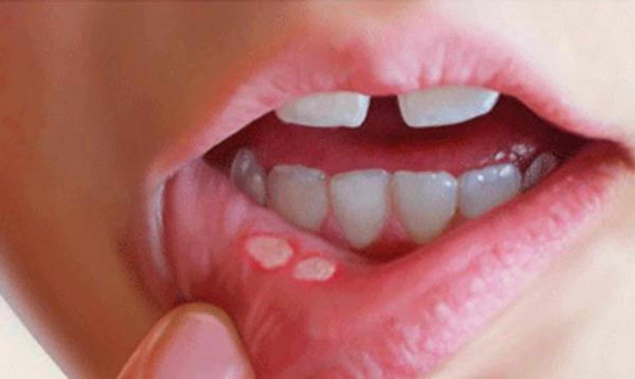 牙床口腔溃疡图片图片