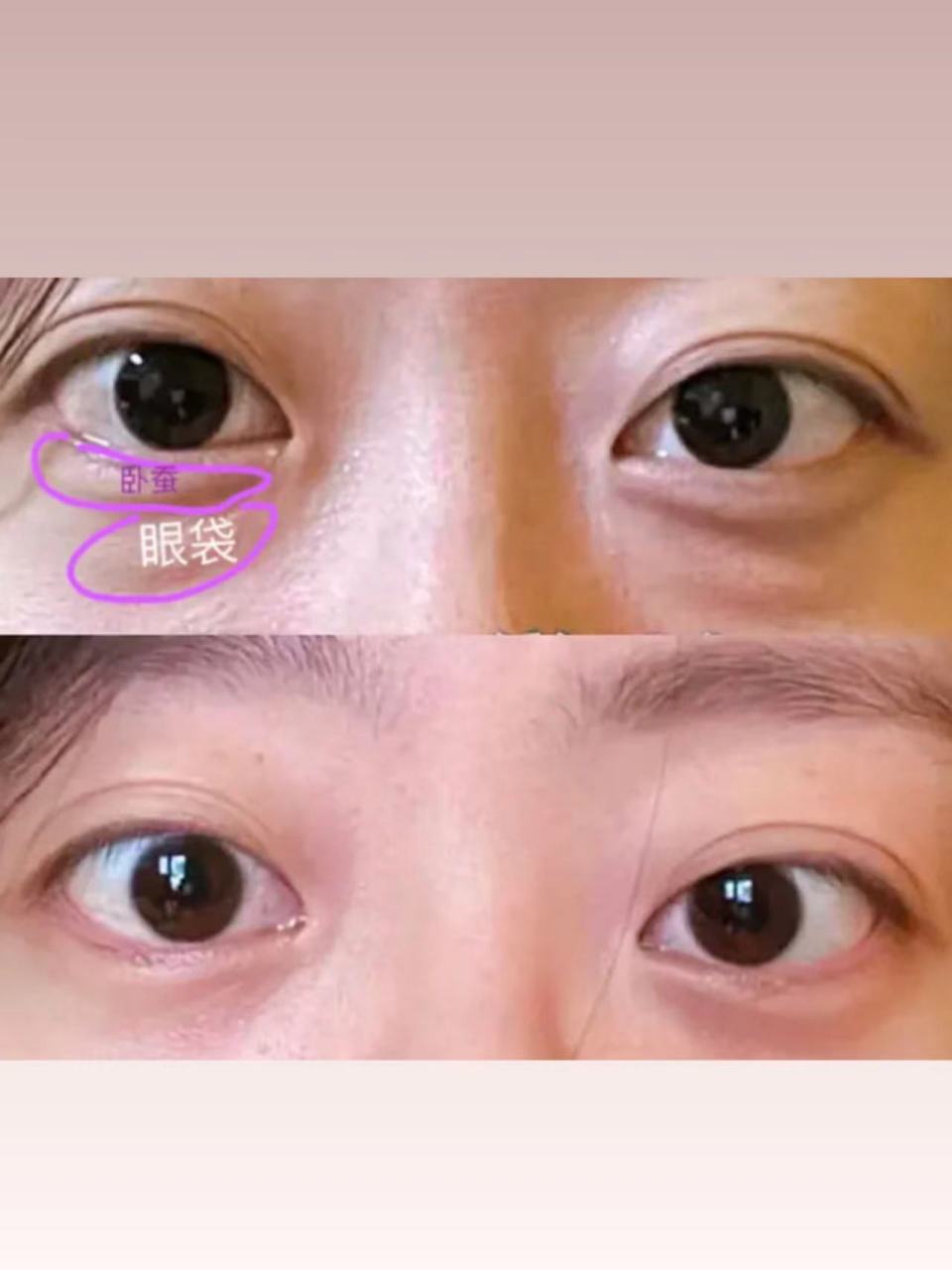 怎么做到去眼袋留卧蚕的?