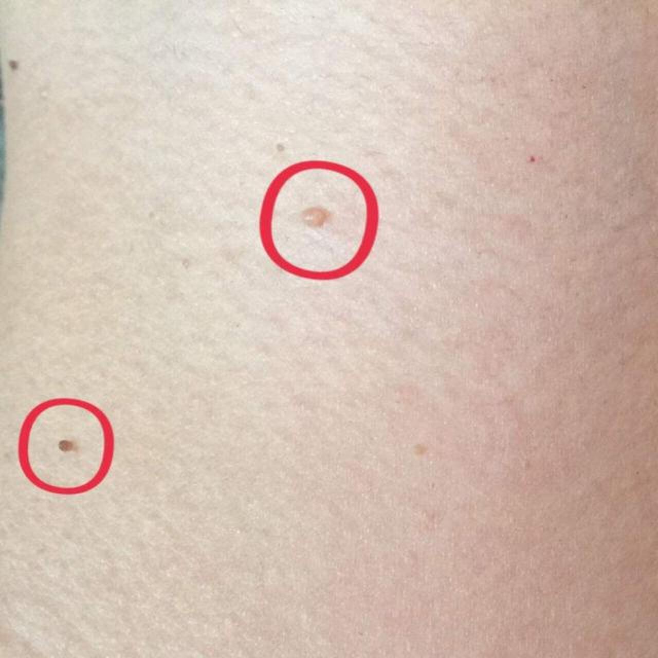 脖子上长出了"小肉粒",别只顾影响美观,当心也会影响健康, 天气炎热的