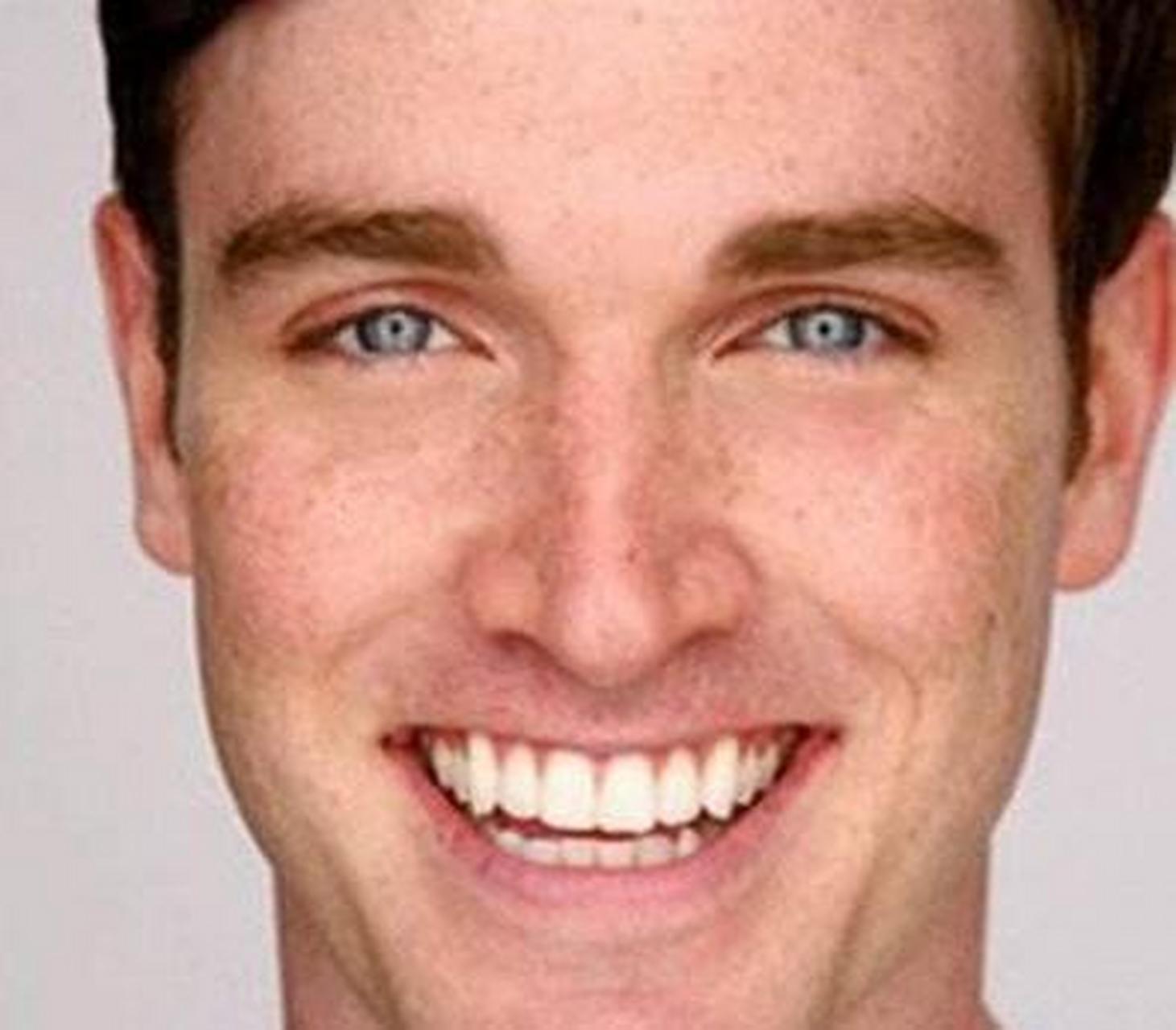 黄褐斑的形成主要是跟体内激素水平的变化有关,男性体内也有这种