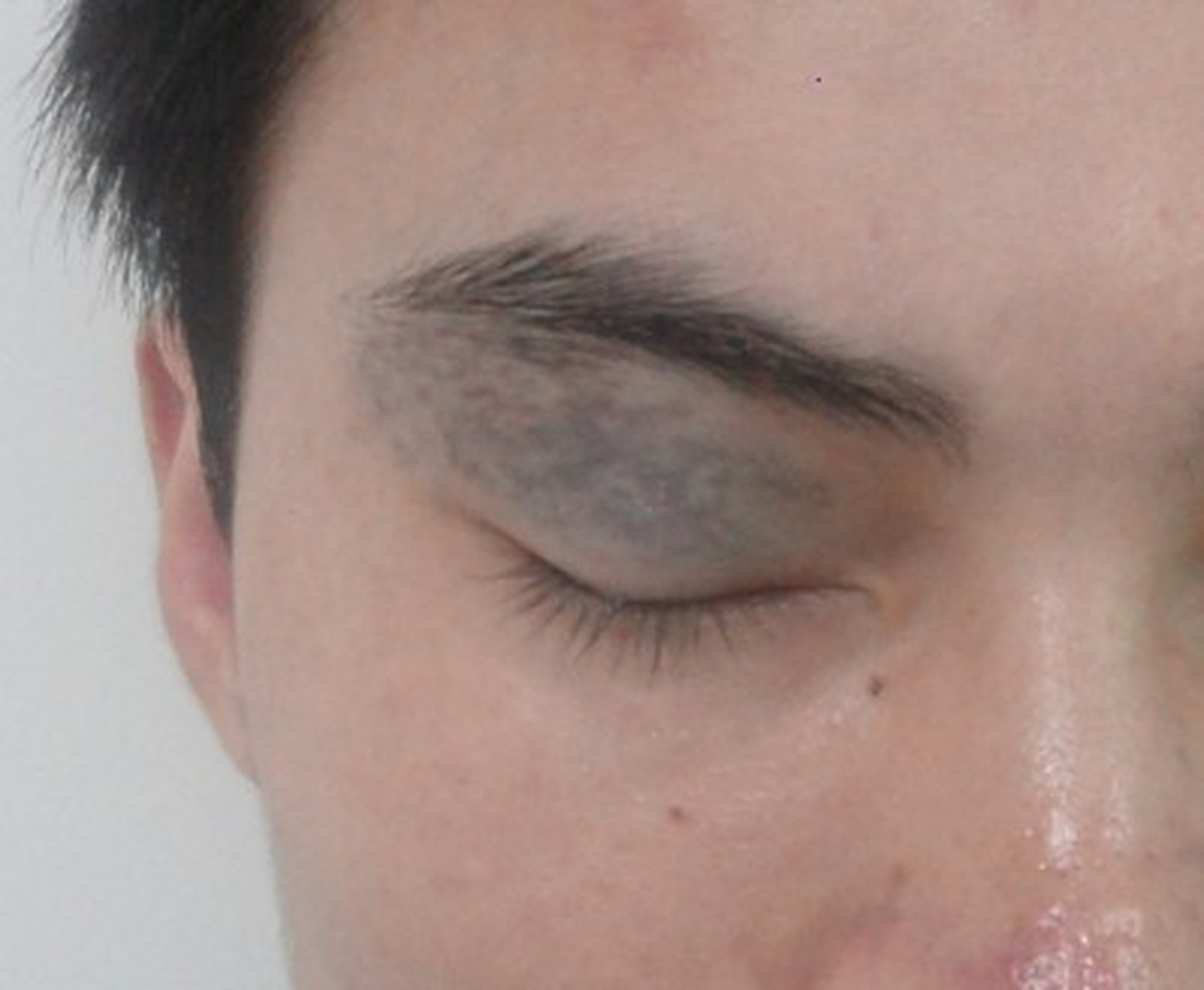 事实上,太田痣不及时治疗,对患者的影响是很大的.