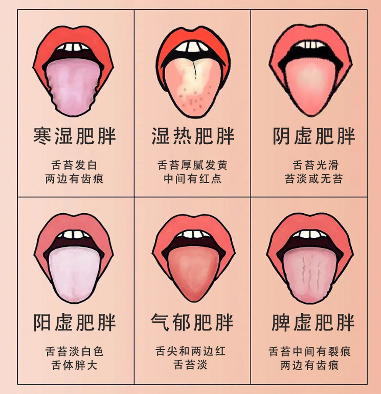 看舌苔辩寒热,对症一方除肥肉  整理出临床肥胖患者常见的四种舌苔,教