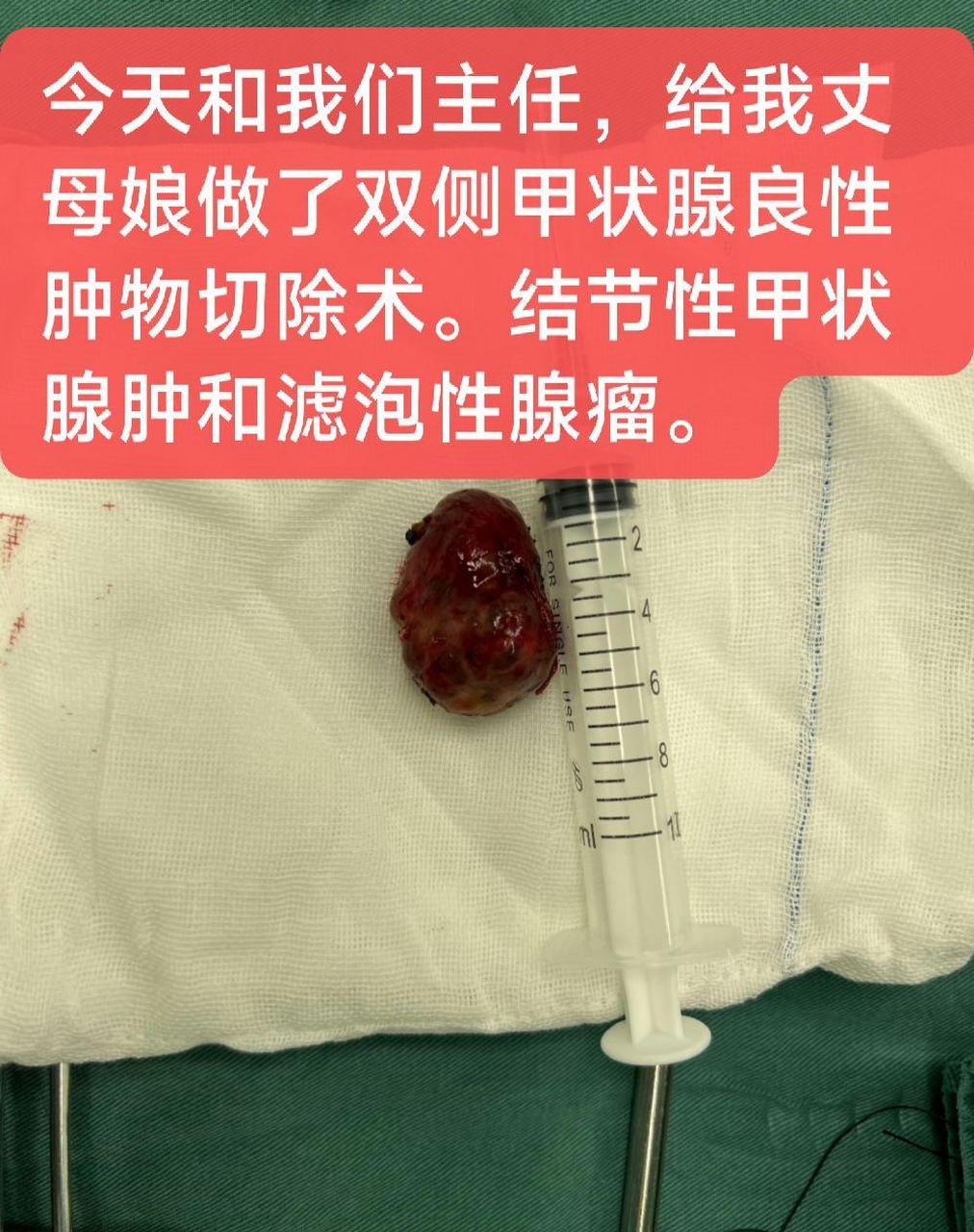 今天和我們主任,給我丈母孃做了雙側甲狀腺良性腫物切除術.