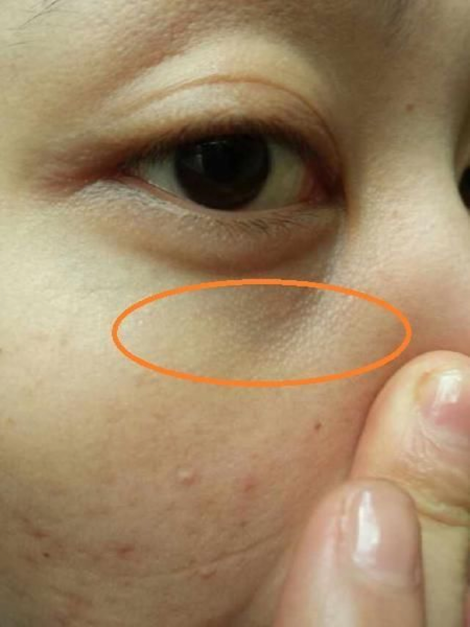 眼皮周围的脂肪粒怎么消除?