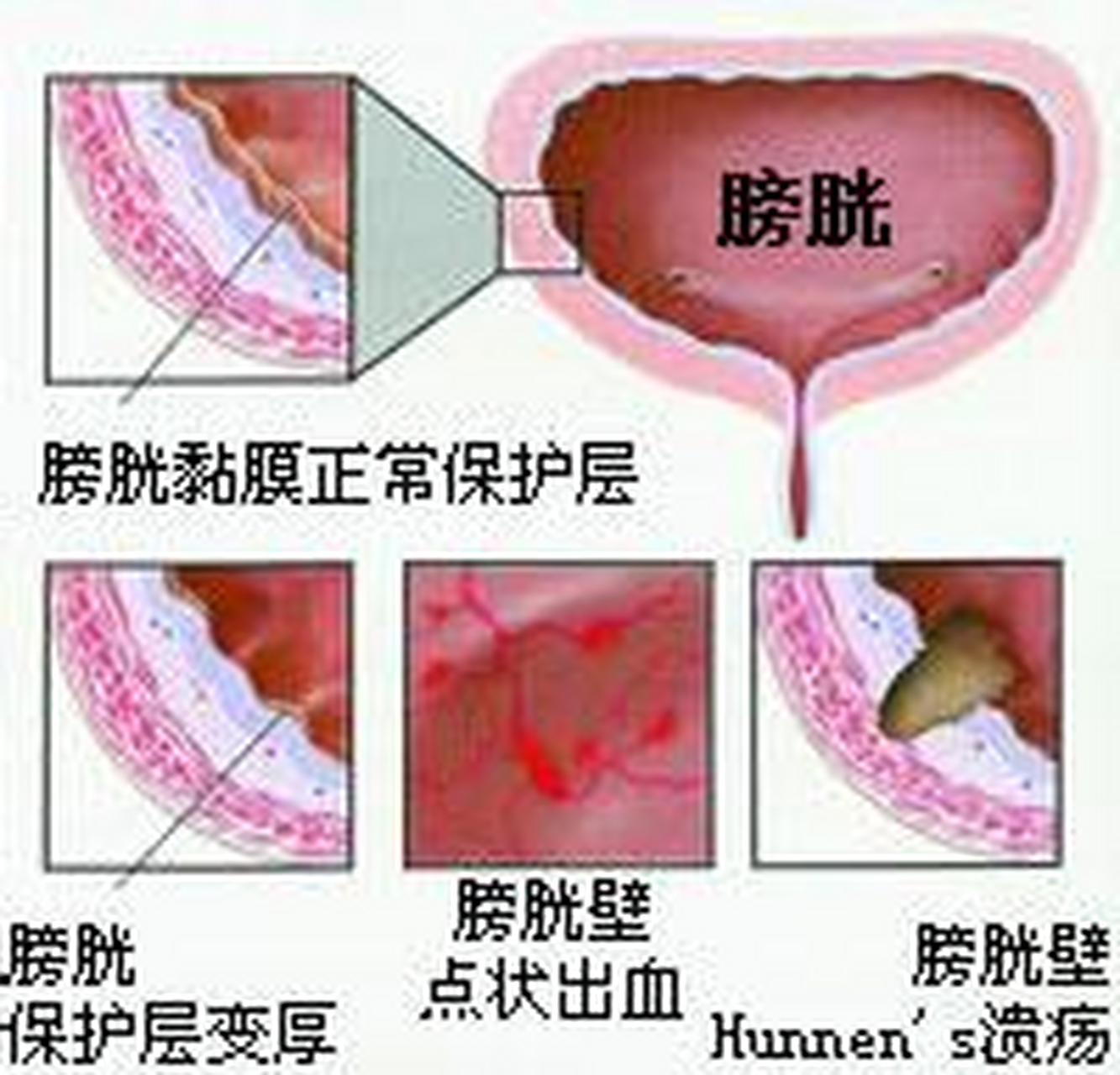 男人膀胱炎是什么症状图片