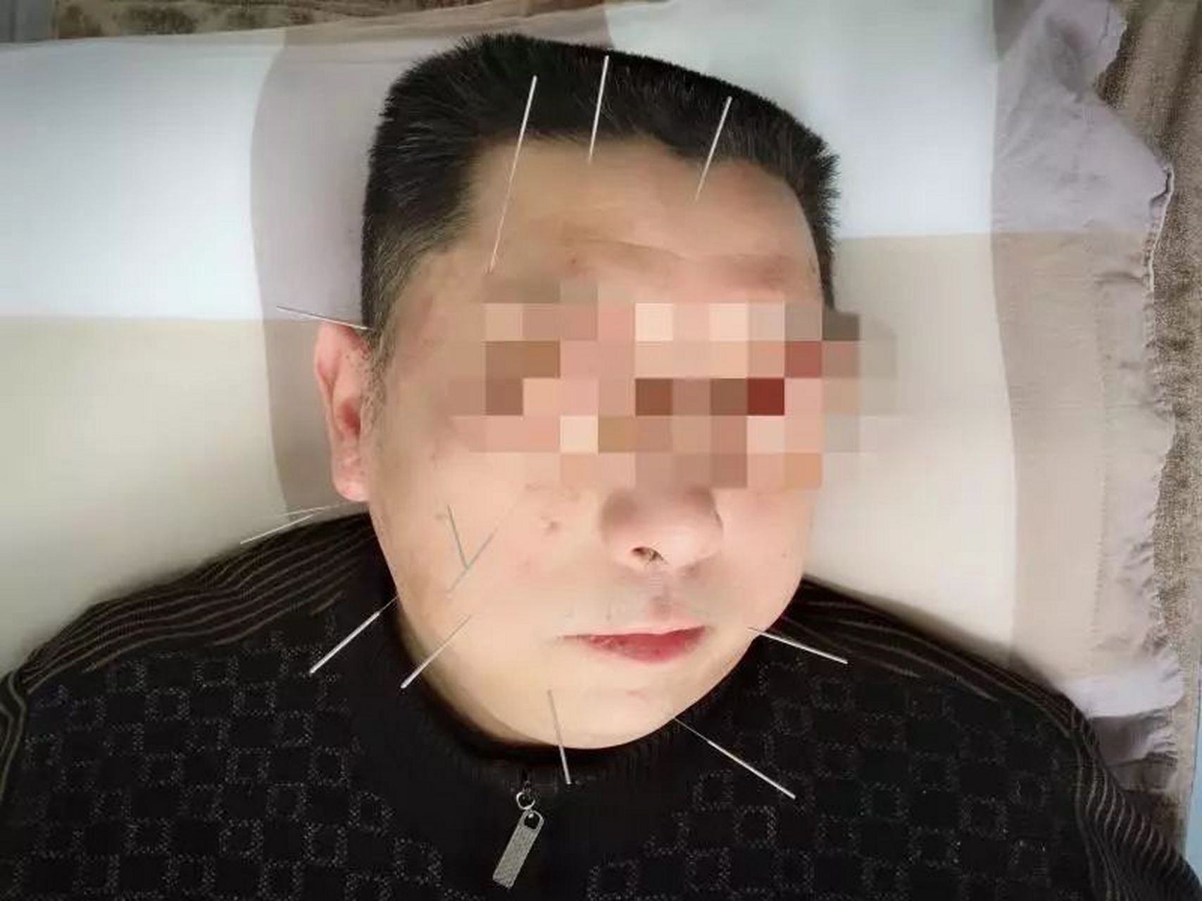 中风嘴歪针灸管用吗?