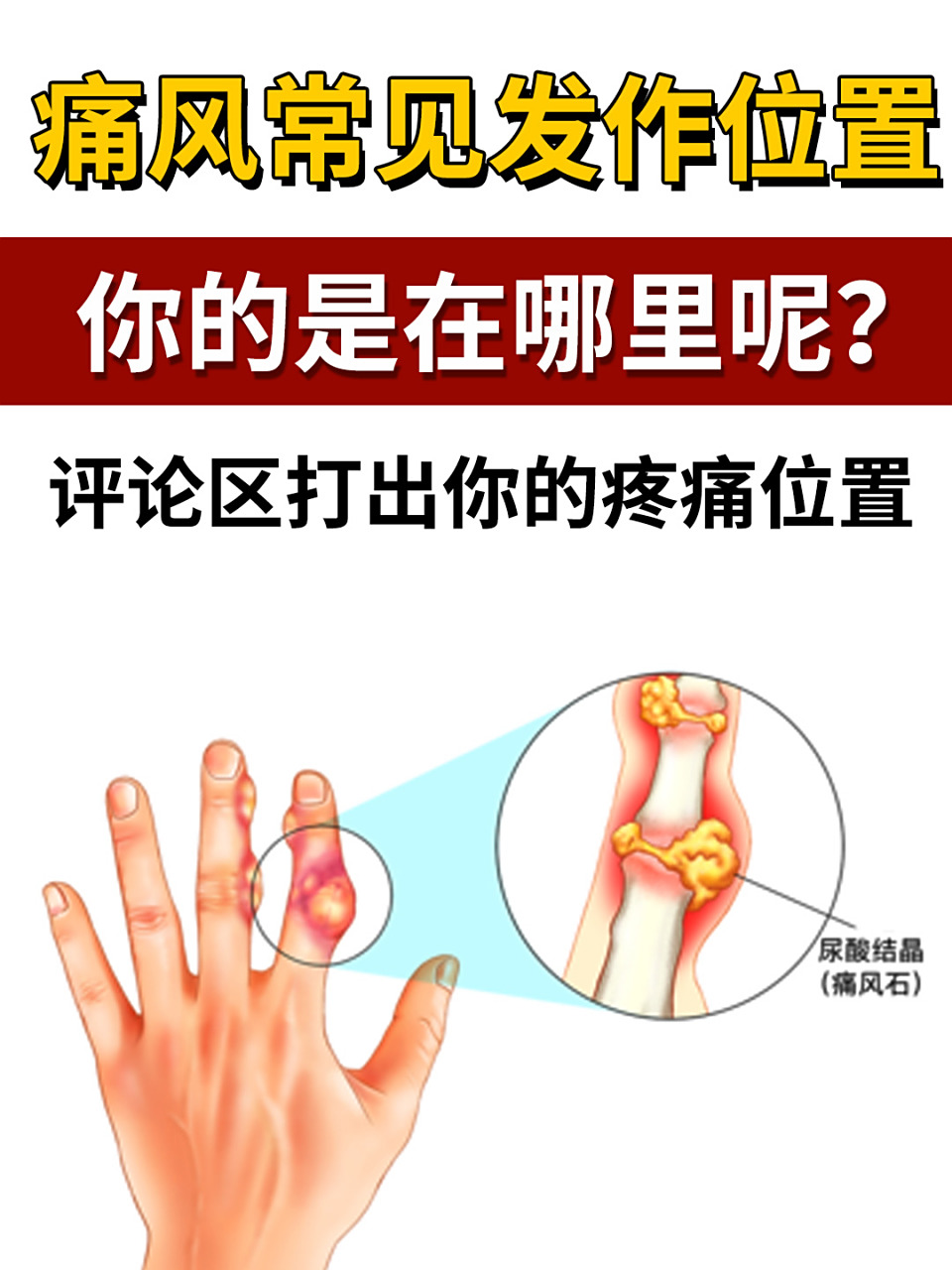 你的痛风发作位置是在哪里呢?