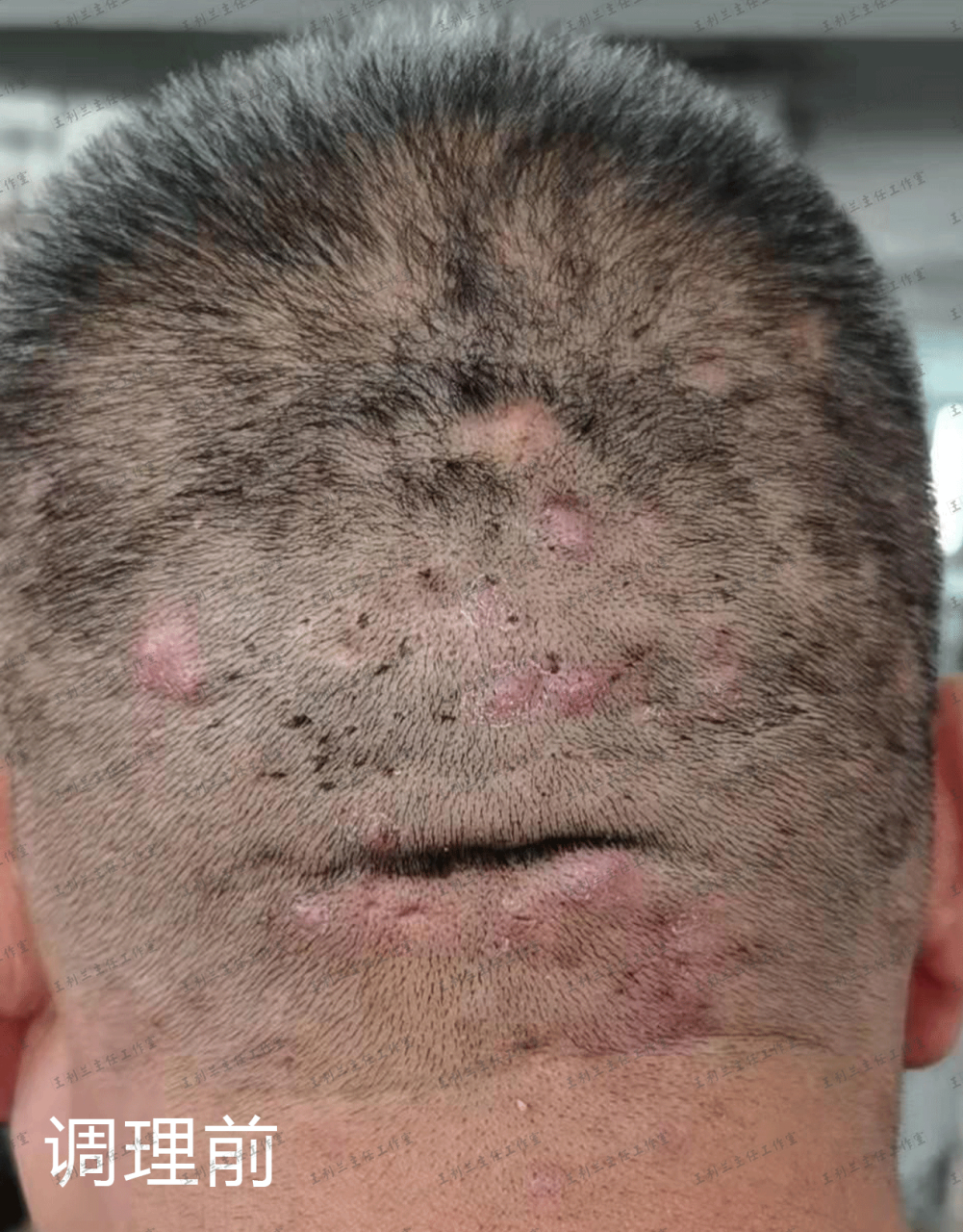 门诊这位中年男子,头上反复长毛囊炎疙瘩,情况比较严重.